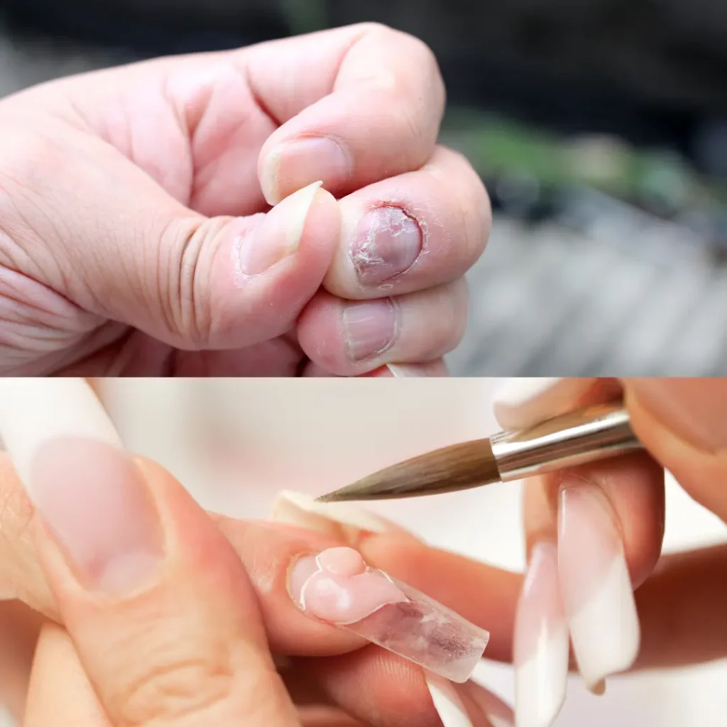Stop! Don’t Apply Acrylic Nails on Fungus Until You Read This Acrylic Nails on Fungus