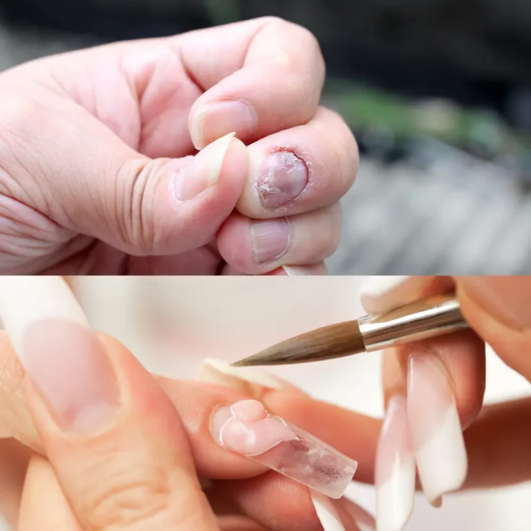 Acrylic Nails on Fungus